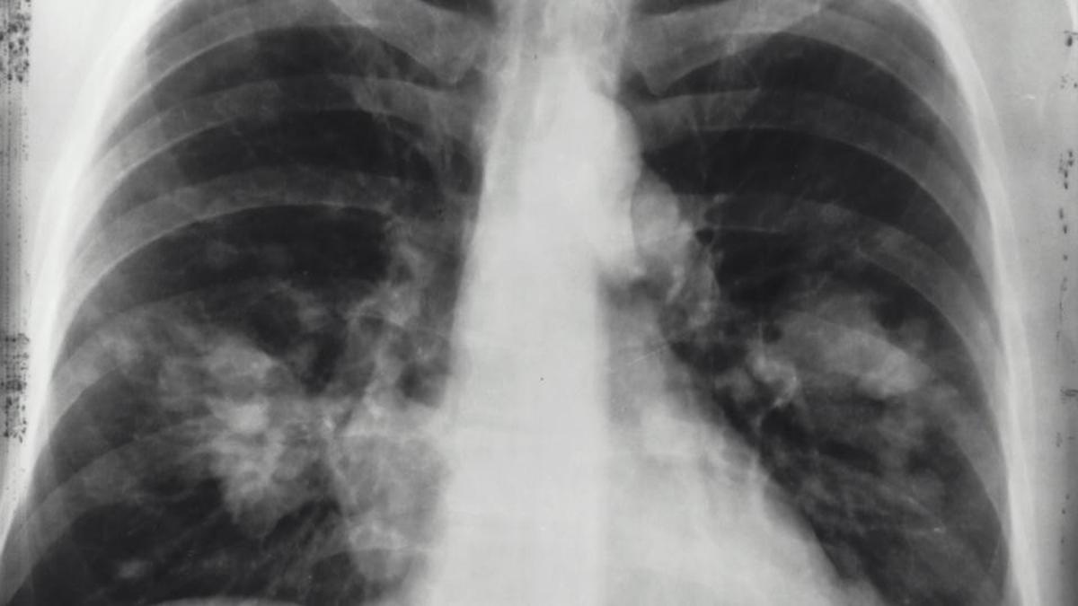 CRUK scientists find new tool to test lung cancer therapies